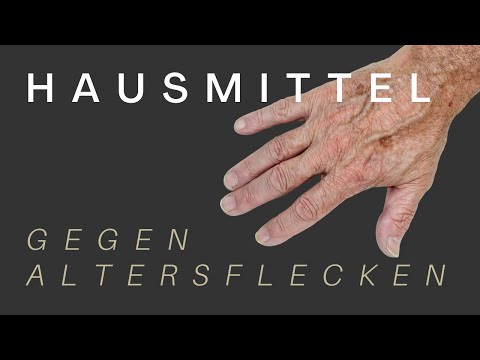 Hausmittel gegen PIGMENTFLECKEN & ALTERSFLECKEN » wie du sie innerhalb KÜRZESTER Zeit los wirst!