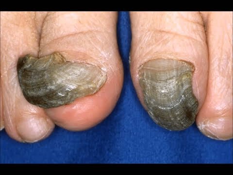 Blackened kuko mula sa masikip na sapatos na paggamot Paggamot ng halamang-singaw sa paa