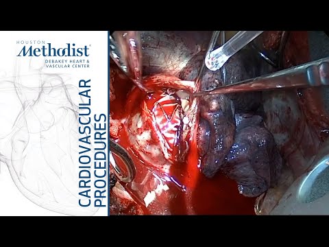 TEVAR Explantation and Aortoesophageal Fistula Repair (MacGillivray, MD, Mohamed, MD, McFall, MD)