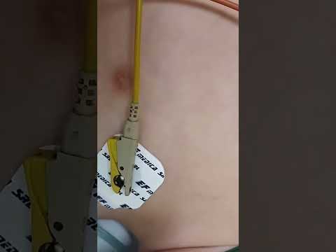 Wheeze, stridor sound (tiếng thở khò khè, thở rít)