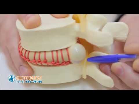 Современные методы лечения  грыжи позвоночника в МЦ Остеократ