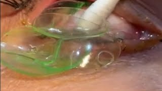 Doctor removes 23 contact lenses from patient