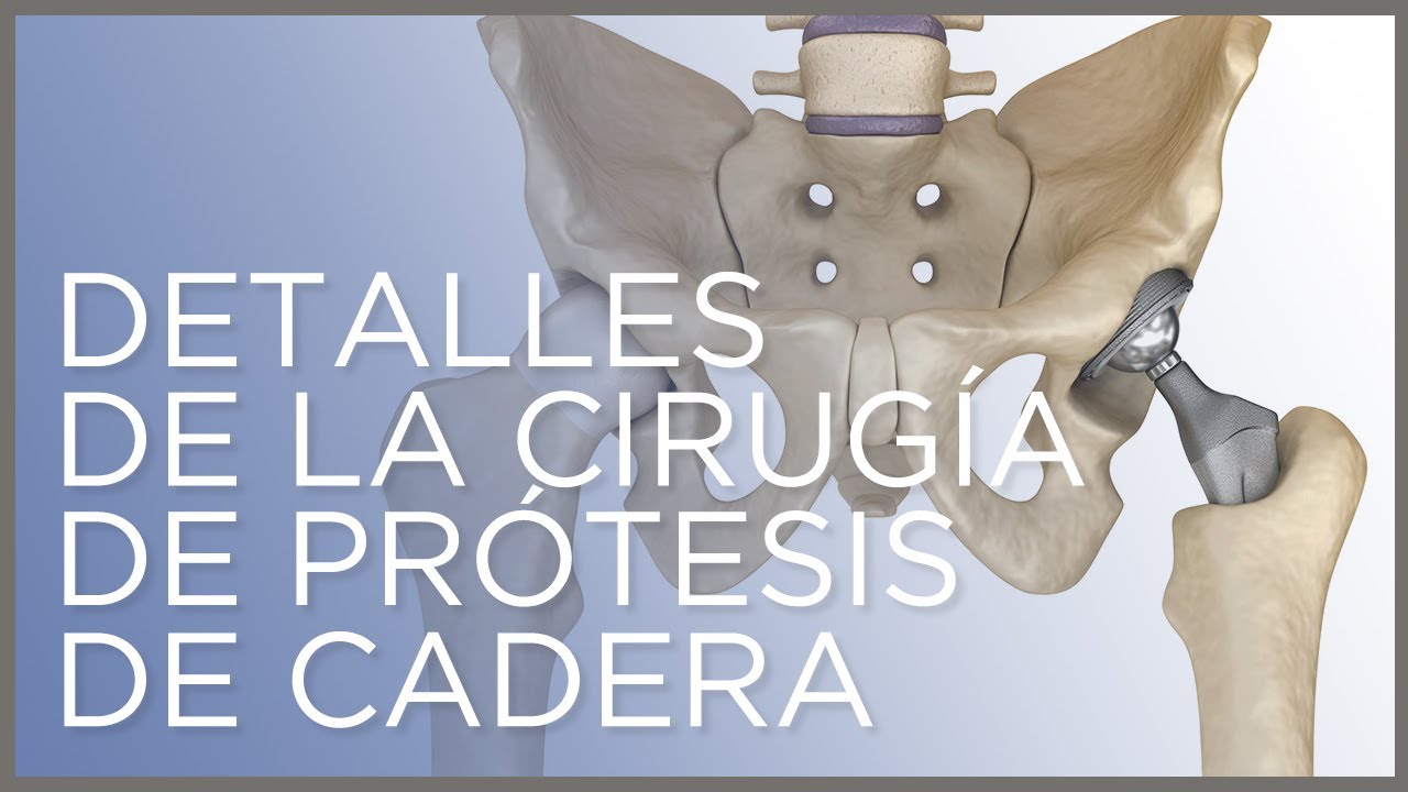 Watch Detalles de la cirugía de prótesis de cadera, Dr. Ángel Villamor Now Detalles de la cirugía de prótesis de cadera, Dr. Ángel Villamor