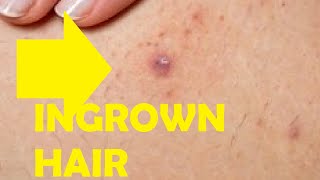 how to get rid of an ingrown hair that has turned into a cyst