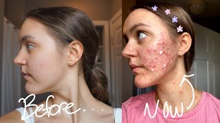 My Acne Came Back... | Cute World Ep 1🌈💜🌼