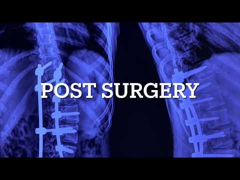 Scoliosis spine surgery: Robotic surgery changing lives and giving new identity