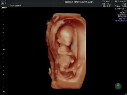 Ecografía 5D 12 semanas embarazo