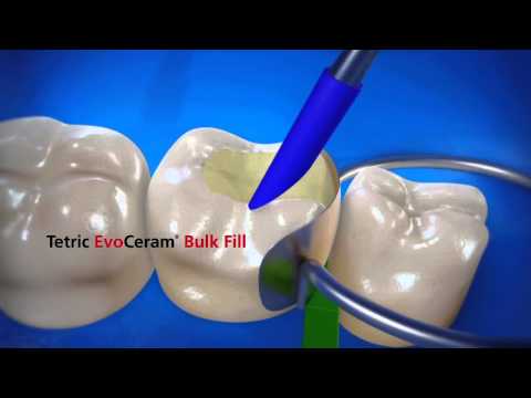 Henry Schein UK -- Tetric EvoCeram Bulk Fill Bluephase Style