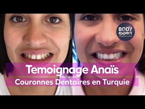 SOINS DENTAIRES  | 🦷 Témoignage Anaïs : 20 couronnes dentaires Emax | BODYEXPERT