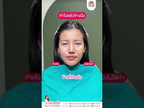 รีวิวหัตถการโปรแกรมฟิลเลอร์ร่องแก้ม
