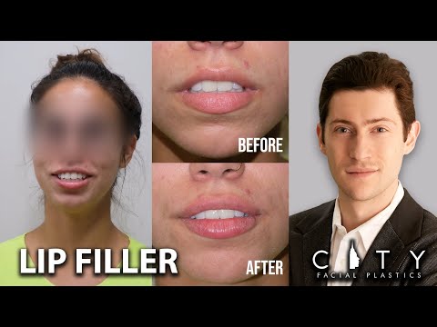 New York Lip Filler