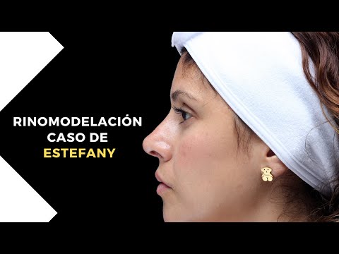 Caso de ESTEFANY – Rinomodelación