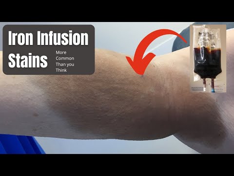 Iron Infusion Stains | How to treat? Dermatologist explains