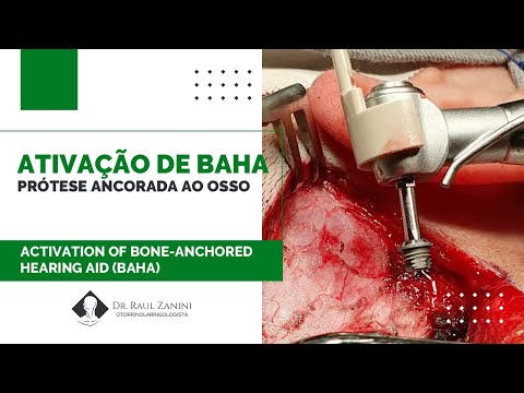 Miniatura: Ativação de Prótese Ancorada ao Osso
