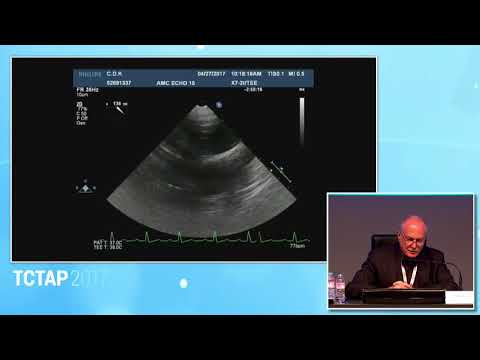 [TCTAP 2017] Valve Symposium - Live Case & Lecture Session IV