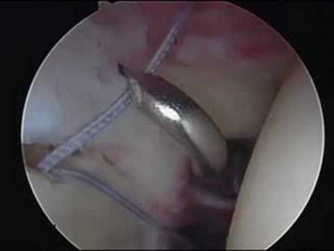 Superior Labrum Anterior To Posterior (SLAP) Arthoscopic Correction