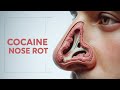 The SHOCKING Truth About Cocaine And Nasal Damage