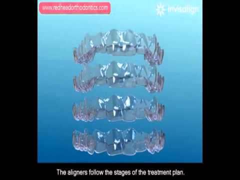 Invisalign Video