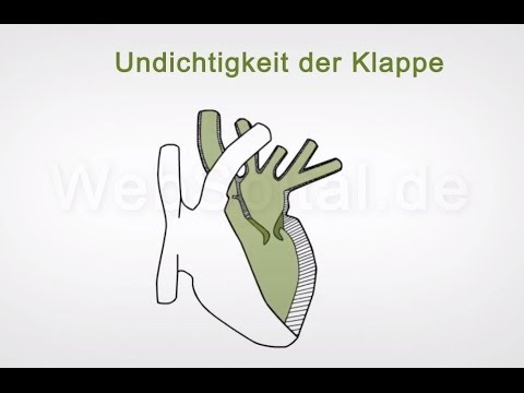 Wie man die Schmerzen in der Rückenmuskulatur während der Schwangerschaft zu lindern Vegetarismus Gelenkschmerzen