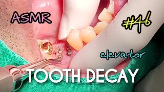[ASMR] Severely Broken, Tooth Decay Extraction