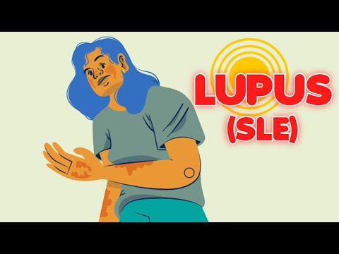 Systemic Lupus Erythematosus (updated 2023) - CRASH! Medical Review Series
