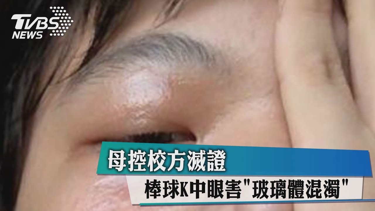 棒球K中眼害「玻璃體混濁」 母控校方滅證