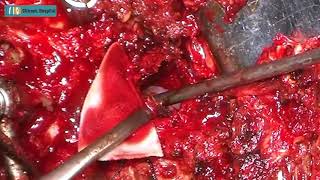 Asymmetric PSO surgery by Dr Amit Jhala