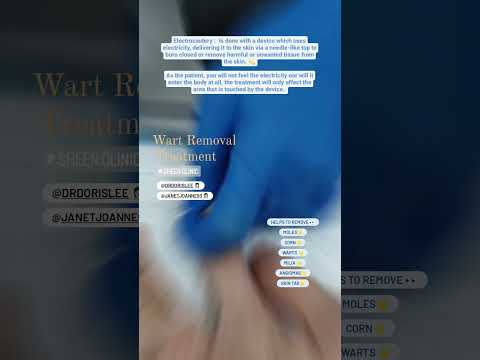 Safe Wart & Skin Tag Remova l Sheen Clinic Subang Jaya