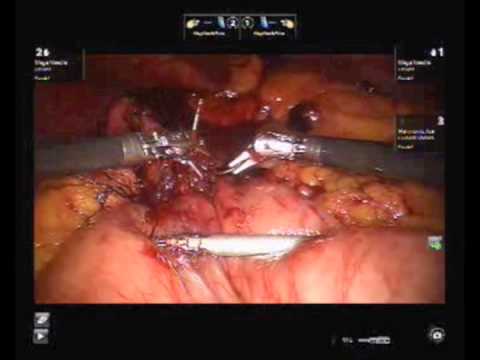 Robotic Gastric Bypass