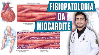 Fisiopatologia da Miocardite - (PORTH Capítulo 32)