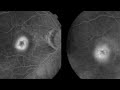 FFA CLASSIFICATION OF CNVM (Choroidal neovascular membrane) | Occult v/s Classic CNVM