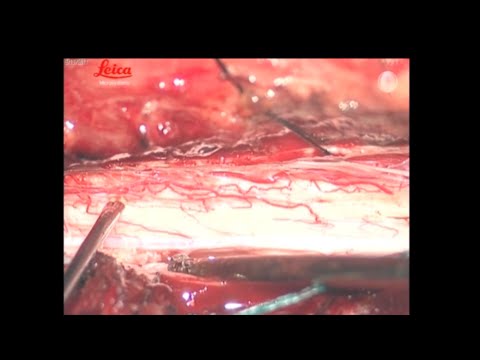 Dorsal root entry zone lesion: nuances of the technique and long-term results in: Neurosurgical Focus: Video Volume 3 Issue 2 (2020) Journals