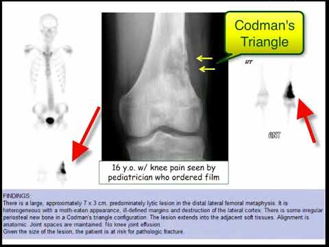 12DaysinMarch, Podcast Series, Bone Tumors (Sarcoma) for the USMLE Step One Exam