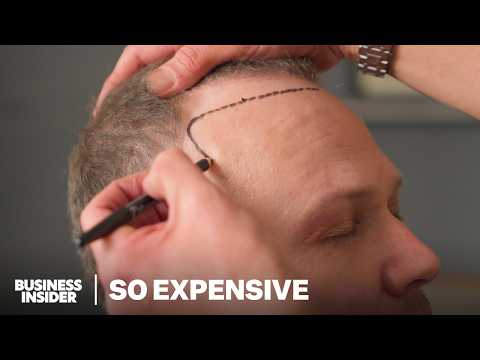 Inside Turkey's $2B Hair Transplant Tourism Boom