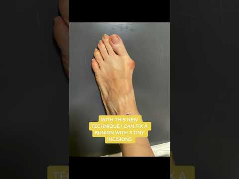 Fixing a Bunion - AMI Bunion Technique