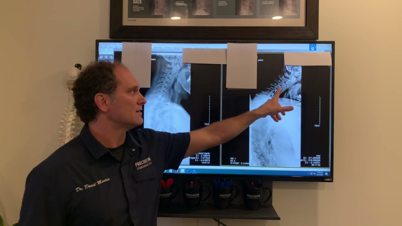 Chiropractic X-Ray Before and After