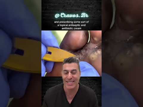 " Fleas " in FOOT