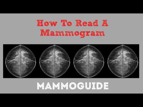 Mammogram Uworld