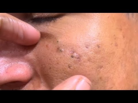 sac be spa blackheads elderly nose | sac be spa old men nose blackheads new 2026 | sac be spa face 