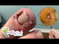 WHAT INGROWING NAIL POKING THROUGH TOE