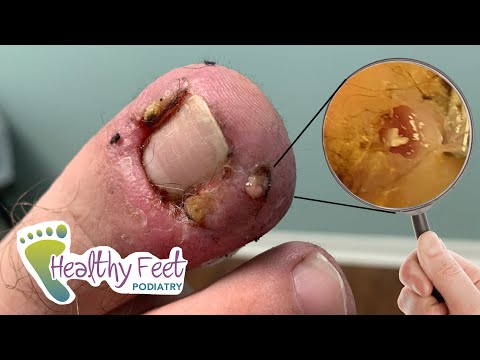 3rd YouTube video about are ingrown toenails genetic