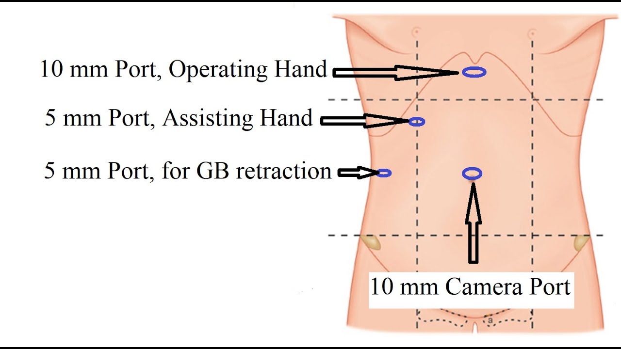 Difficult Lap Chole Bile Duct