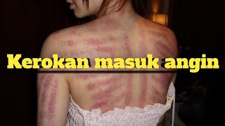 Download lagu Kerokan tradisional//klip video mp3