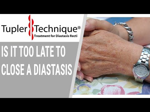 Is It Too Late to Close a Diastasis- Julie Tupler, RN