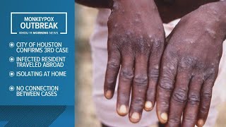 Third Houston resident confirmed to have monkeypox