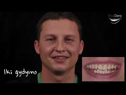 svorio netekimas ortodontija 38 negali numesti svorio