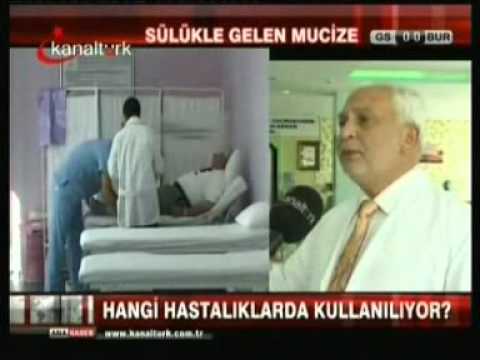 Sülük Tedavisi İle İlgili Haber ve Videolar