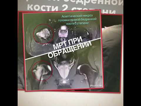Протезирование коленного сустава по квоте в волгограде Причина боль в пояснице отдает в ягодицу