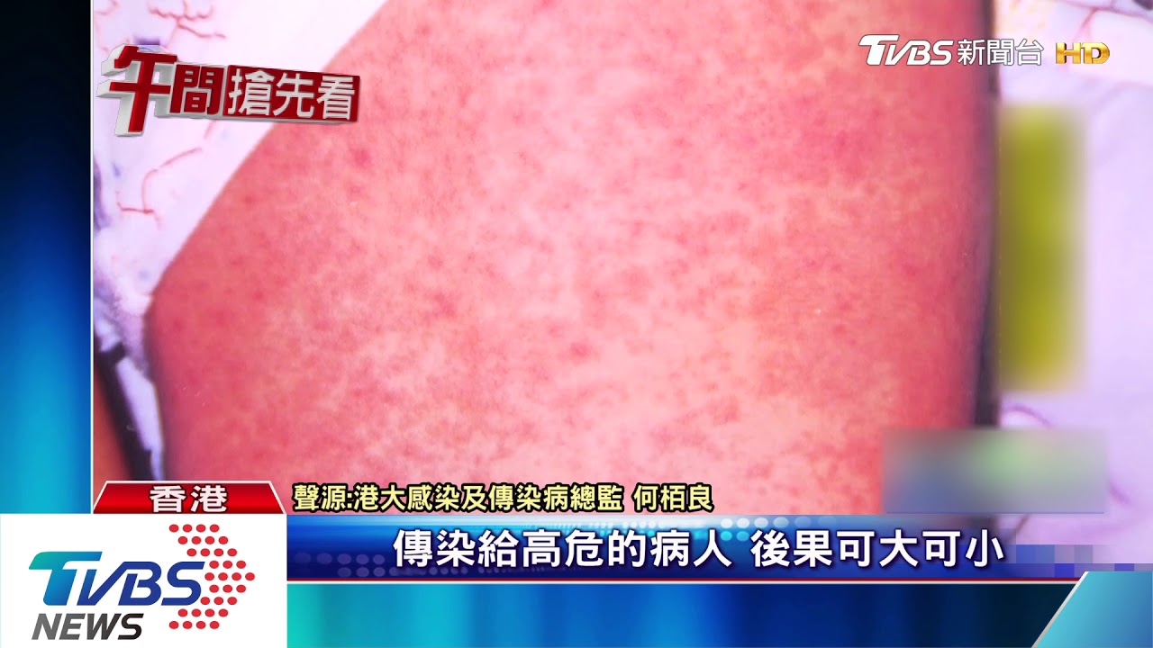 香港爆麻疹疫情 空服員、機師相繼確診