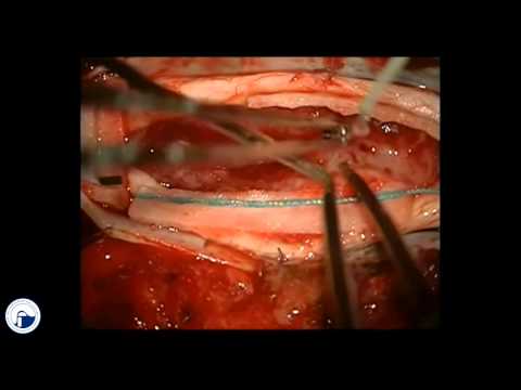 Rückenschmerzen und Husten Der Schwachpunkt des Schultergelenkes